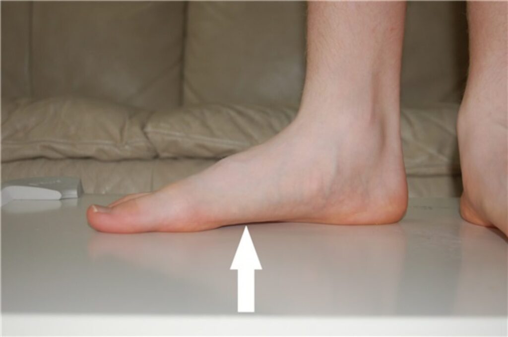 فلات فوت .. القدم المسطحة .. علاج الفلات فوت .. Flat foot