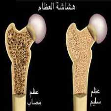 أعراض هشاشة العظام وما هي مراحل هشاشة العظام وما هي أسباب هشاشة العظام