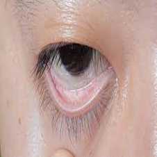 أعراض مرض فقر الدم من العين