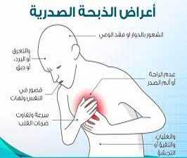 أعراض الذبحة الصدرية عند النساء وما هي طرق علاج الذبحة الصدرية