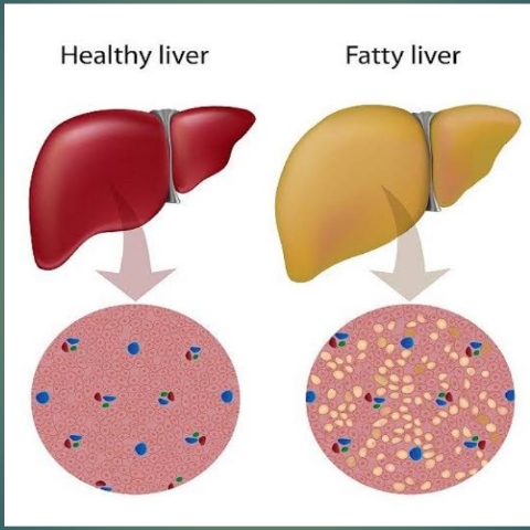 أسباب الكبد الدهني Fatty Liver