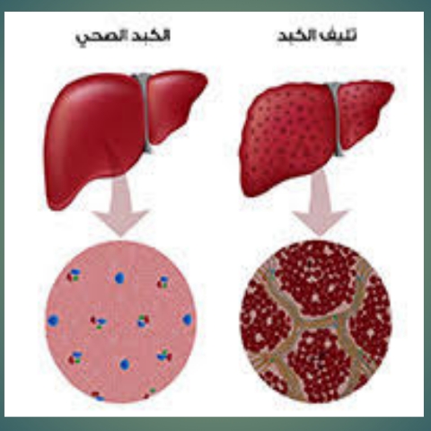 أعراض مرض تليف الكبد Liver  Cirrhosis