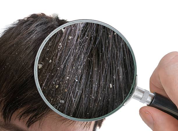 أسباب قشرة الشعر في الشتاء
