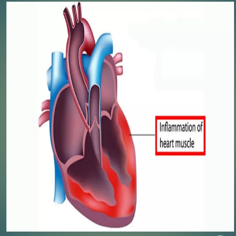 أسباب التهاب عضلة القلب