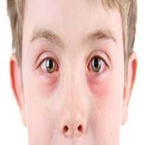 أسباب احمرار العين عند الأطفال وطرق علاجها وكيفية الوقاية