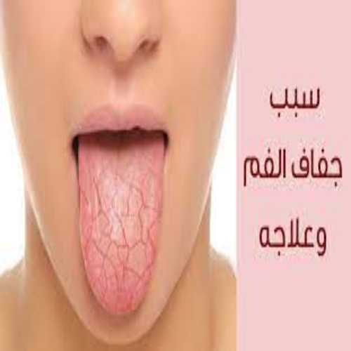 أسباب جفاف الفم .. وما هي أعراض وطرق علاج جفاف الفم