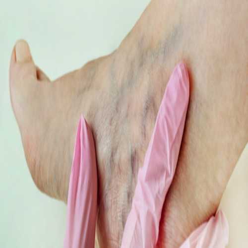 أعراض جلطة الساق .. وما هي طرق الوقاية من جلطة الساق