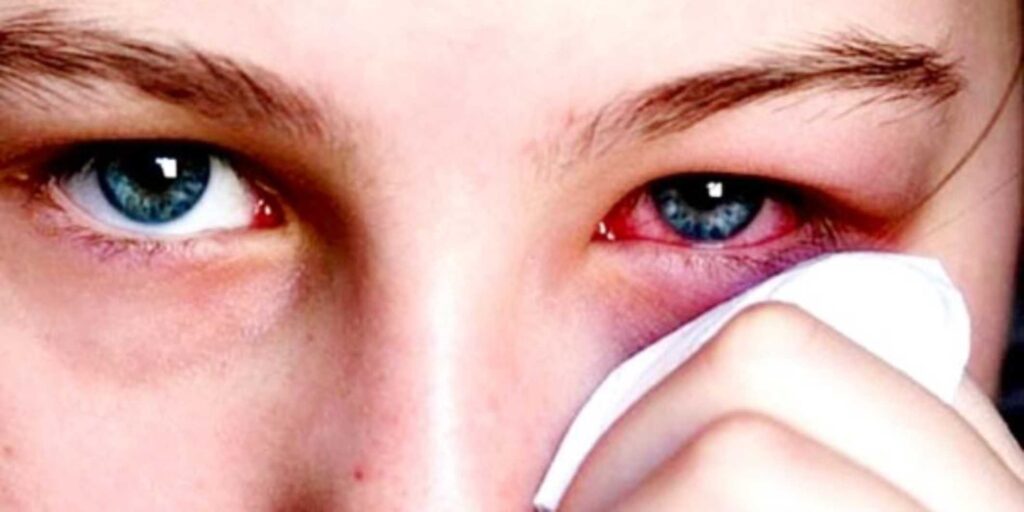 هل يمكن علاج جلطة العين بالطب البديل