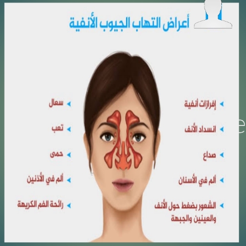أعراض التهاب الجيوب الأنفية الحاد