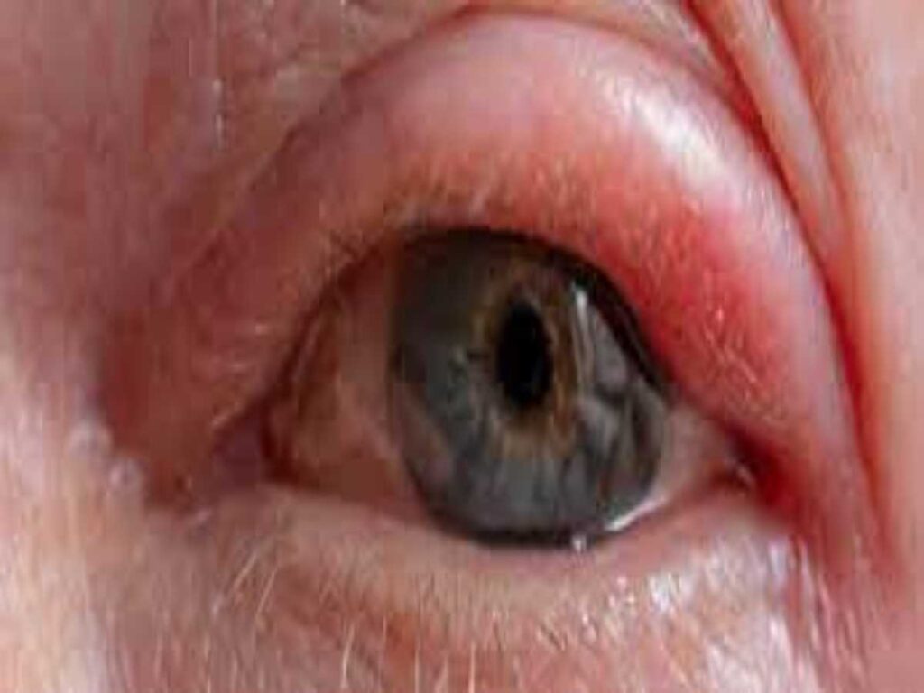 علاج انتفاخ العين من فوق .. وما هي أعراض وأسباب انتفاخ العين من فوق